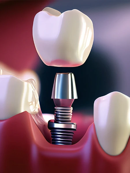 Почему стоит выбрать стоматологическую клинику "Умут" для имплантации зубов?