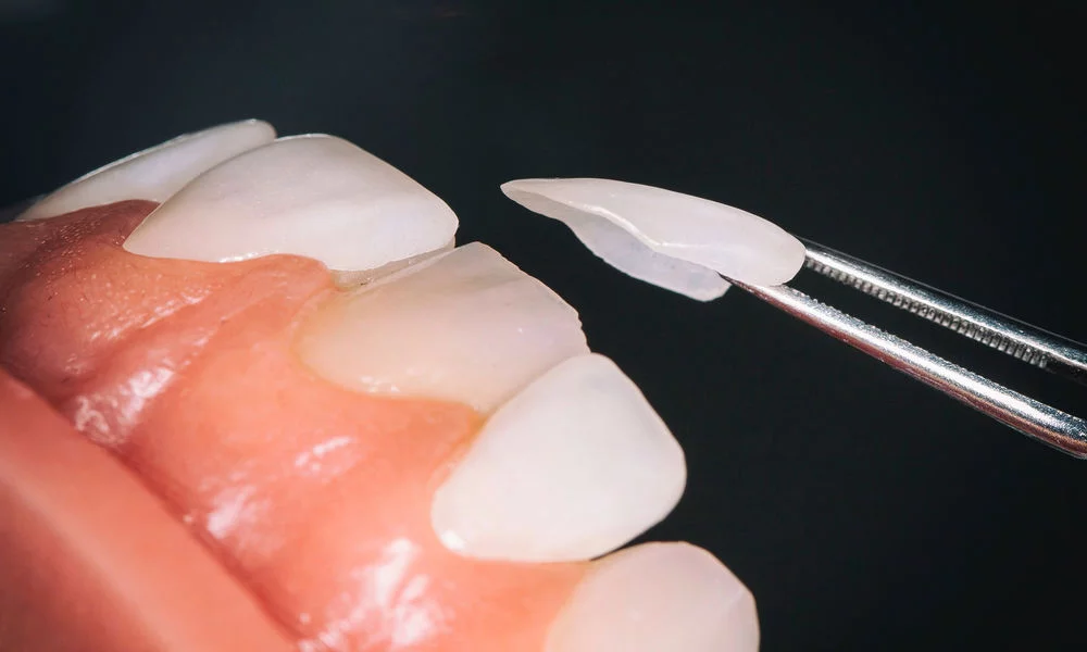 What Are Laminate Veneers and Composites?