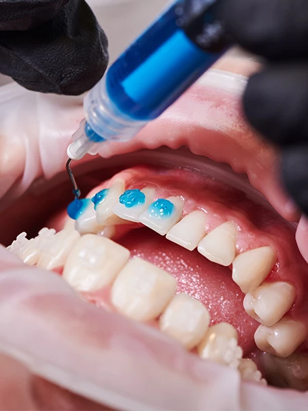 What Are Laminate Veneers and Composites?