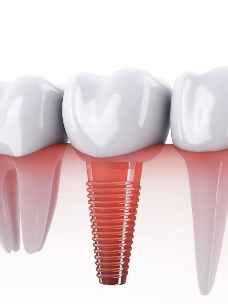 Avantages des implants dentaires All-on-4