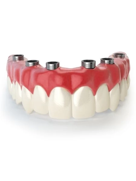Implants dentaires All-on-6 à Antalya
